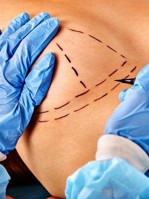 Chirurgie voor borstvergroting